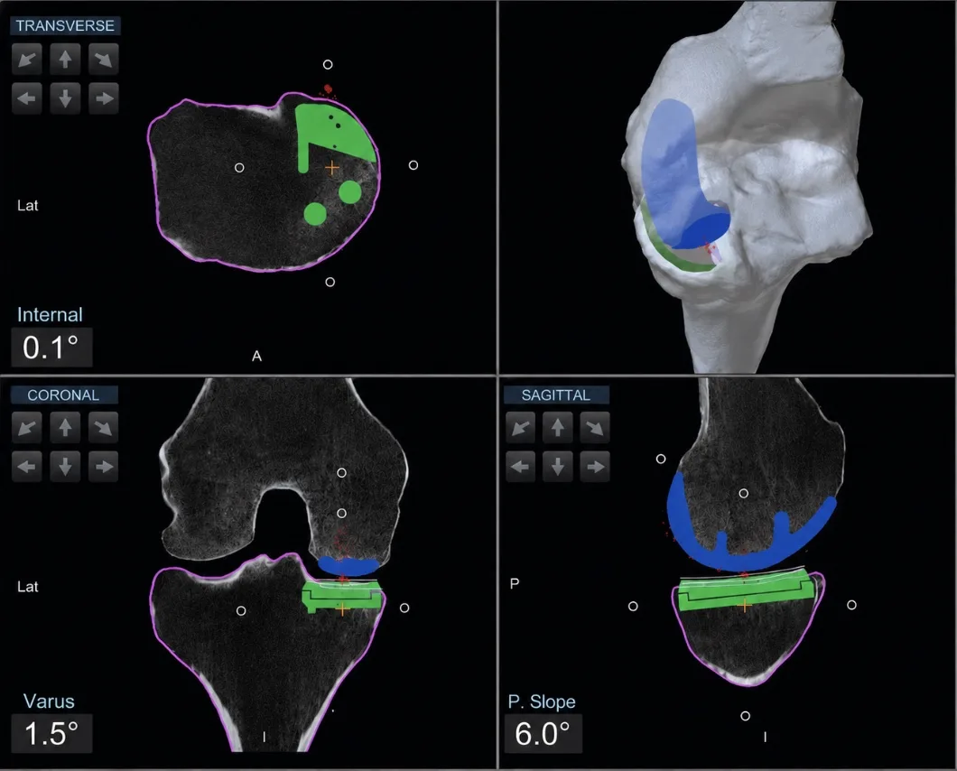 Knee replacement